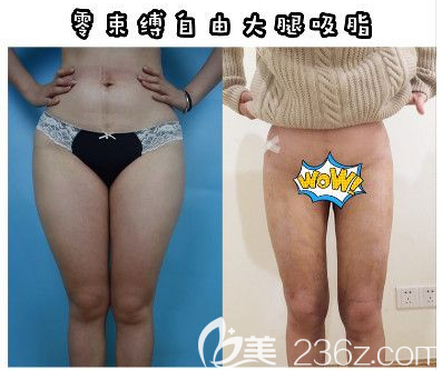 深圳德漾整形醫(yī)院梁志生吸脂案例 深圳德漾整形醫(yī)院梁志生吸脂案例