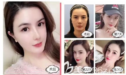 深圳麗港麗格石東文做自體脂肪填充全臉效果圖