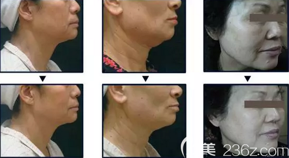 韓國美璞兒超第刀第三代案例效果對比圖