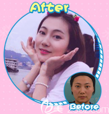 遵義韓美玻尿酸填充全臉案例