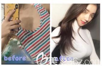 廉鋒主任隆胸案例 廉鋒主任隆胸案例