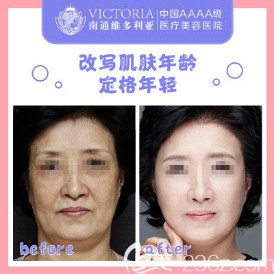 李冬穎醫(yī)生除皺美白對(duì)比案例 李冬穎醫(yī)生除皺美白對(duì)比案例