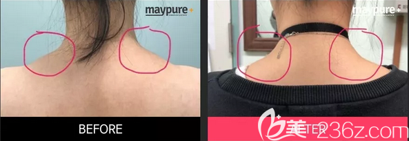 韓國(guó)美璞兒張俊哲瘦肩注射位置圖片前后效果對(duì)比