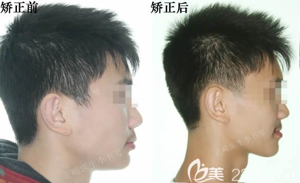 重慶維樂李書琴深覆合矯正后牙齒及臉型變化圖 重慶維樂李書琴深覆合矯正后牙齒及臉型變化圖