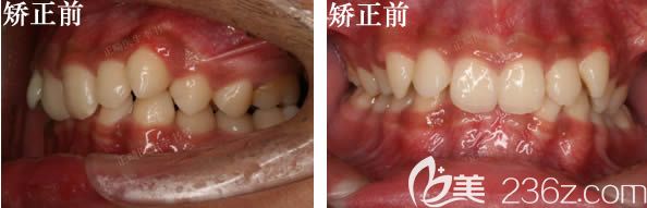 13歲男孩內傾性深覆合矯正術前照 13歲男孩內傾性深覆合矯正術前照