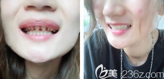 廈門登特口腔詹明毅全瓷牙修復(fù)效果對比圖