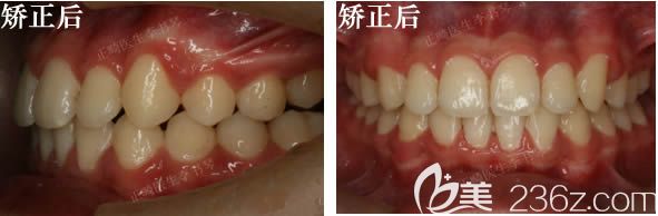 深覆頜矯正后的牙齒變化 深覆頜矯正后的牙齒變化