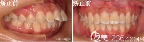 22歲顧客深覆蓋矯正術前照 22歲顧客深覆蓋矯正術前照