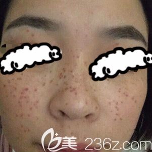 我在青海西寧時光醫(yī)院激光祛斑術后第1天