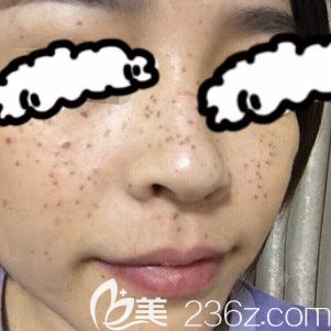 我在青海西寧時光醫(yī)院激光祛斑術后第3天