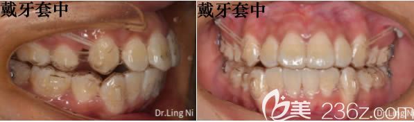 拔牙后戴牙套的照片 拔牙后戴牙套的照片