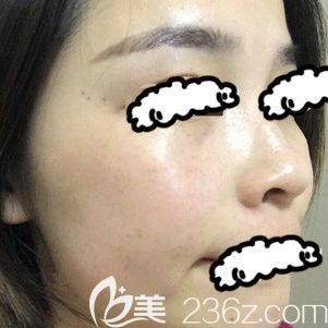 我在青海西寧時光醫(yī)院激光祛斑術后第18天<span style=