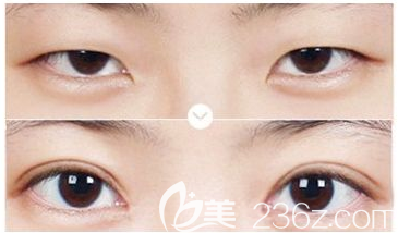 東莞締美韓先奎做雙眼皮怎么樣 東莞締美韓先奎做雙眼皮怎么樣