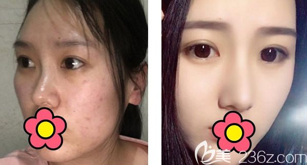 呼和浩特大韓隆鼻整形怎么樣