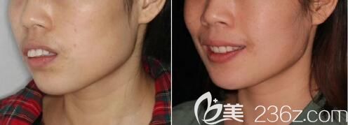 中山好民生雷永正齙牙矯正前后效果對比圖