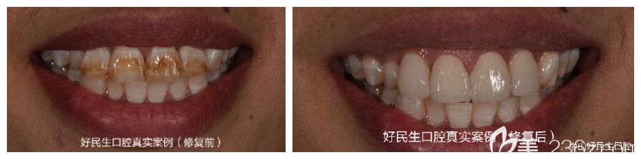 中山好民生口腔雷永正怎么樣？雷院長精品案例呈現(xiàn)