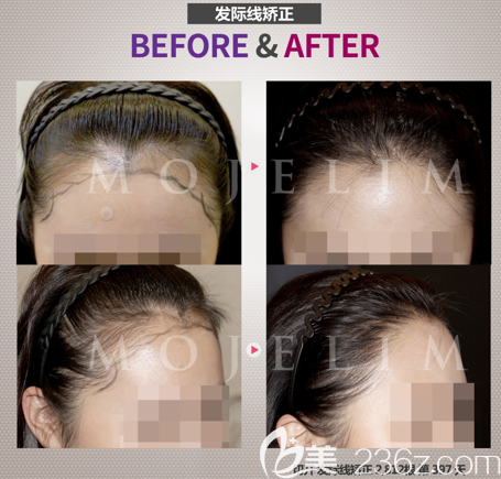 韓國毛杰琳女性發(fā)際線種植2812根真人案例