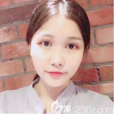 朱曉梅醫(yī)生眼綜合術后三天效果圖 朱曉梅醫(yī)生眼綜合術后三天效果圖