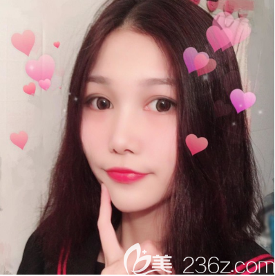 東莞維多利亞朱曉梅醫(yī)生雙眼皮手術案例 東莞維多利亞朱曉梅醫(yī)生雙眼皮手術案例