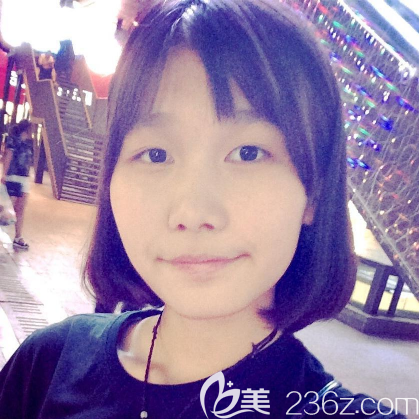 在東莞維多利亞做雙眼皮術前照片 在東莞維多利亞做雙眼皮術前照片