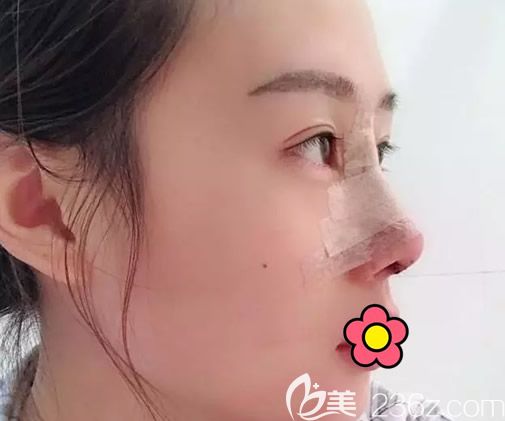 大韓整形金成植博士假體隆鼻+耳軟骨墊鼻尖第四天效果