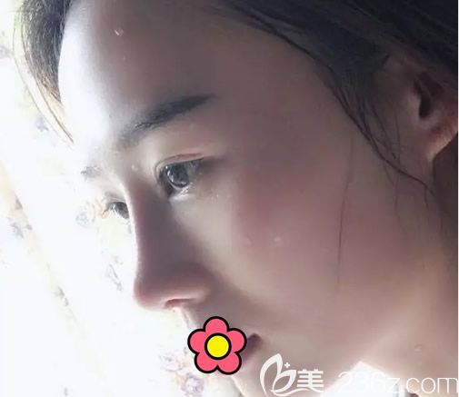 硅膠假體隆鼻第20天恢復(fù)圖