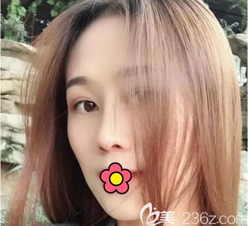 趁著韓國JK整形金成植院長(zhǎng)來呼和浩特大韓整形坐診 我讓他做了假體隆鼻+自體耳軟骨隆鼻手術(shù)