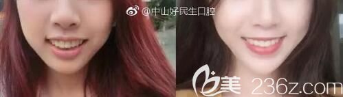 中山好民生口腔正畸怎么樣？張華醫(yī)生精品牙齒矯正案例公布