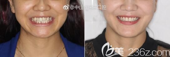 張華牙齒不齊、虎牙矯正案例