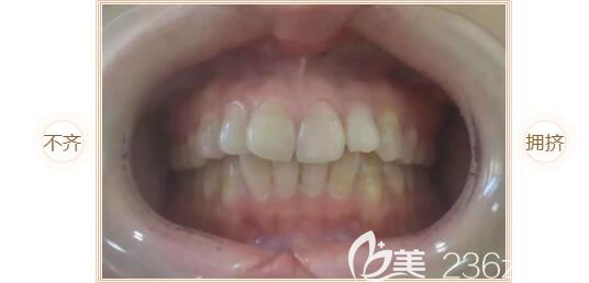 去中山好民生口腔做矯正前口內(nèi)照 去中山好民生口腔做矯正前口內(nèi)照