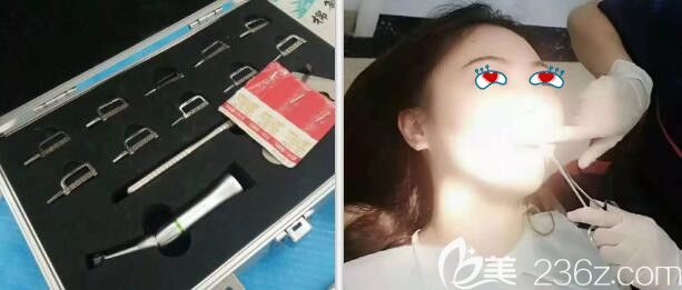 中山好民生口腔牙齒矯正片切過程 中山好民生口腔牙齒矯正片切過程