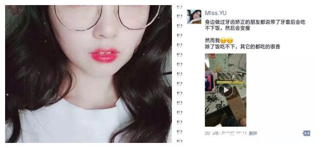 雷永正戴牙套矯正過程體驗(yàn) 雷永正戴牙套矯正過程體驗(yàn)