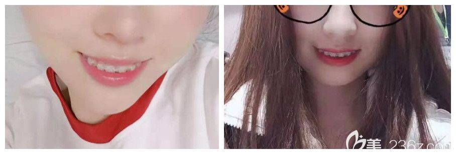 找雷永正做牙齒矯正100天效果圖 找雷永正做牙齒矯正100天效果圖