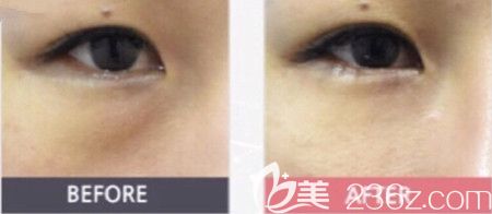 韓國(guó)DIVA眼底脂肪重置手術(shù)案例 韓國(guó)DIVA眼底脂肪重置手術(shù)案例