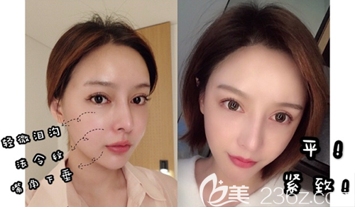 韓國(guó)DIVA面部案例 韓國(guó)DIVA面部案例