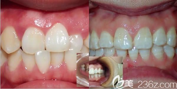 廈門登特口腔醫(yī)院正畸案例效果對比圖