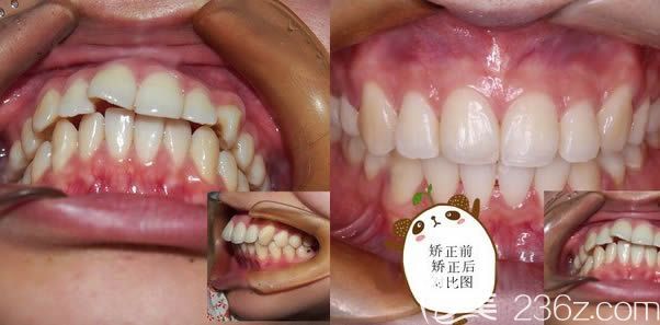 廈門登特口腔暴牙矯正效果前后對比圖