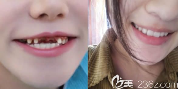 廈門登特口腔連鎖前牙種植前后對比效果圖