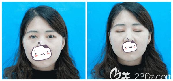 找孫欣醫(yī)生做埋線雙眼皮修復(fù)術(shù)后一個月恢復(fù)情況 找孫欣醫(yī)生做埋線雙眼皮修復(fù)術(shù)后一個月恢復(fù)情況