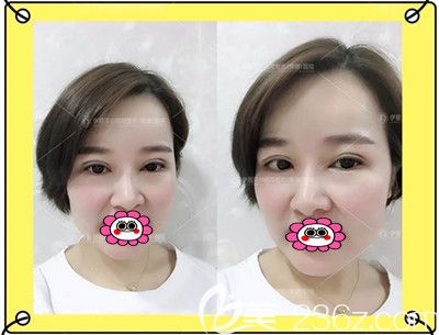 雙眼皮修復(fù)術(shù)后3個(gè)月變化圖