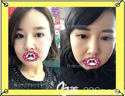 全切雙眼皮修復(fù)術(shù)后1個(gè)月效果圖