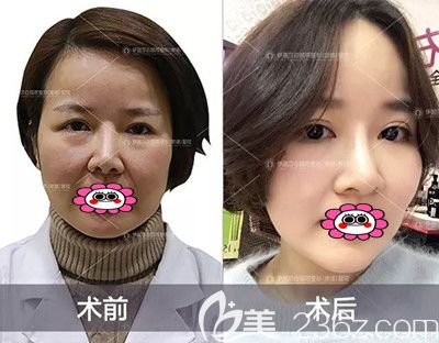 半年前我趁著活動(dòng)在常德伊麗莎白做了全切雙眼皮修復(fù)，效果怎么樣看圖說(shuō)話