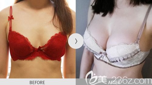 韓國麥恩脂肪隆胸案例