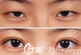 長(zhǎng)春中妍整形美容醫(yī)院王洋眼部綜合案例效果對(duì)比圖
