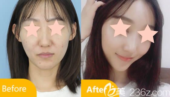 長(zhǎng)春中妍整形馬速里主任鼻綜合案例效果圖