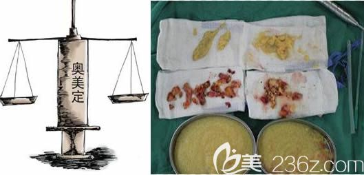 長(zhǎng)春中妍整形取出奧美定注射物內(nèi)容 長(zhǎng)春中妍整形取出奧美定注射物內(nèi)容