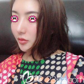 在北京美萊做超皮秒祛斑第13天效果