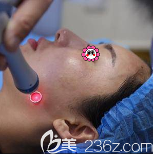 劉崇醫(yī)生給我做超皮秒祛斑當(dāng)天照