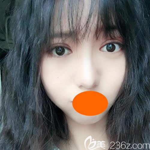 面診上饒尚美整形劉育鳳后才知道新月型雙眼皮更適合我臉型