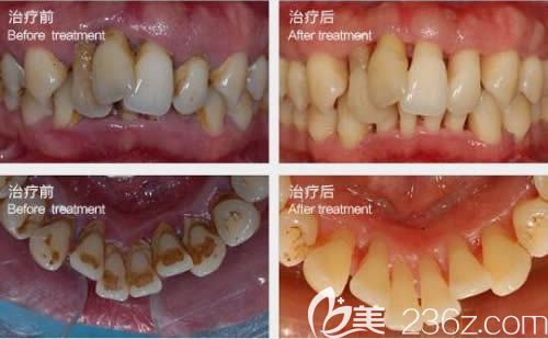 廈門登特口腔<!--<i data=20240703-sp></i>-->穎醫(yī)生牙周病治療前后對(duì)比圖